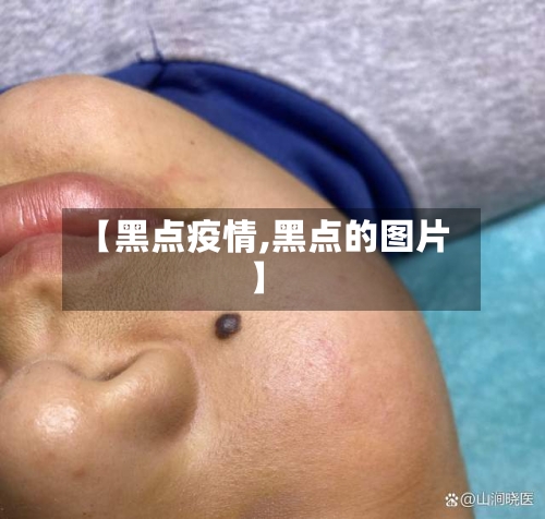 【黑点疫情,黑点的图片】