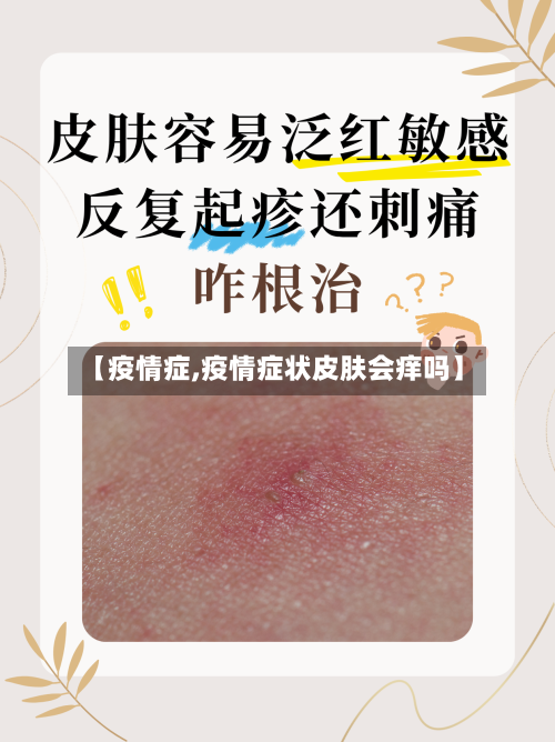 【疫情症,疫情症状皮肤会痒吗】-第3张图片