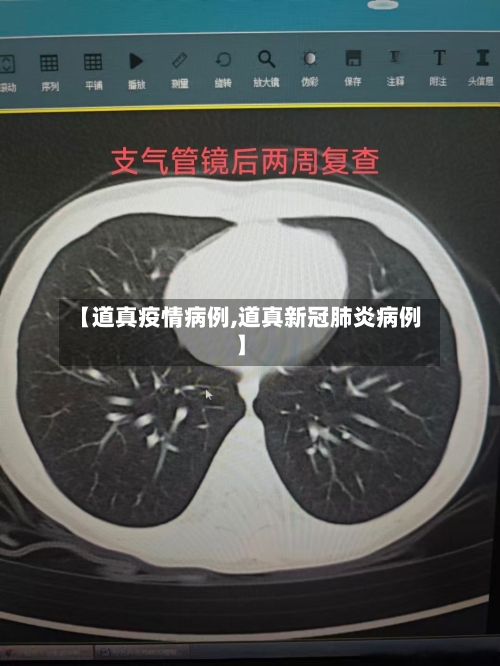 【道真疫情病例,道真新冠肺炎病例】